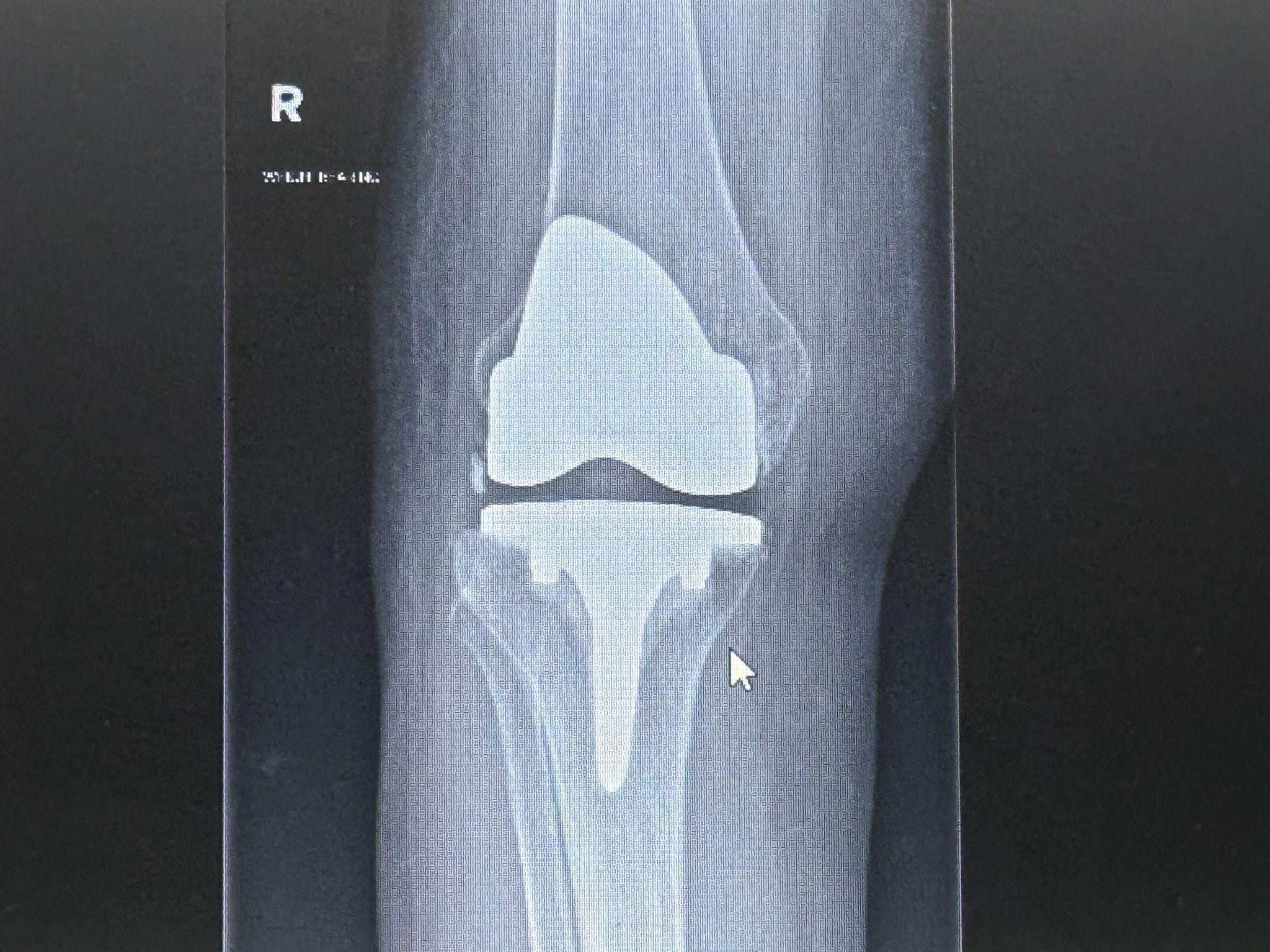Knee Replacement Surgery