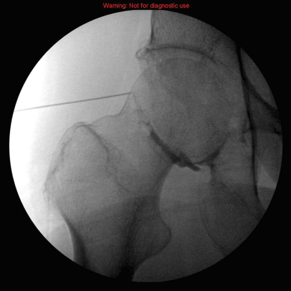 Image-Guided Injections